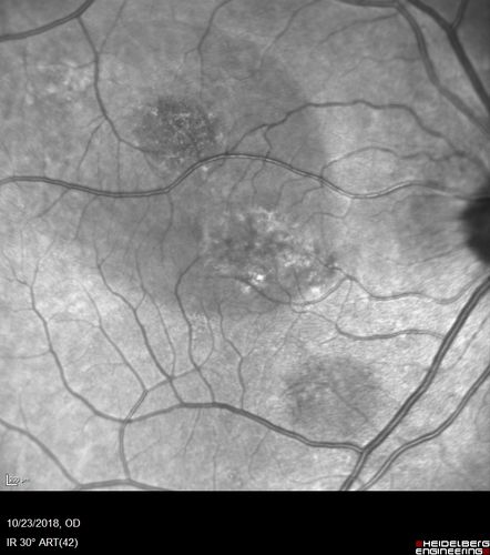 Chronic CSC Both Eyes - Recent vision loss Right Eye Treated with PDT
50 year old man The right eye has had vision loss for a few weeks.  He had previous episodes seen by me in 2012 OS and 2008 OD.  This was 2018. VA OS has been poor for several years.  
VA OD: Dcc20/100 
VA OS: Dcc20/200-3
The patient had PDT to leaky area superotemporal to the fovea 1/2 dose and within 3 months was back up to 20/25.  The last two OCT scans show fluid absorbing
