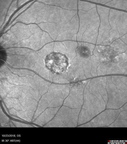 Chronic CSC Both Eyes - Recent vision loss Right Eye Treated with PDT
50 year old man The right eye has had vision loss for a few weeks.  He had previous episodes seen by me in 2012 OS and 2008 OD.  This was 2018. VA OS has been poor for several years.  
VA OD: Dcc20/100 
VA OS: Dcc20/200-3
The patient had PDT to leaky area superotemporal to the fovea 1/2 dose and within 3 months was back up to 20/25.  The last two OCT scans show fluid absorbing
