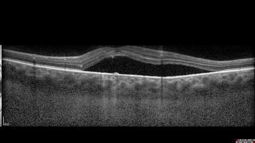 Chronic CSC Both Eyes - Recent vision loss Right Eye Treated with PDT
50 year old man The right eye has had vision loss for a few weeks.  He had previous episodes seen by me in 2012 OS and 2008 OD.  This was 2018. VA OS has been poor for several years.  
VA OD: Dcc20/100 
VA OS: Dcc20/200-3
The patient had PDT to leaky area superotemporal to the fovea 1/2 dose and within 3 months was back up to 20/25.  The last two OCT scans show fluid absorbing
