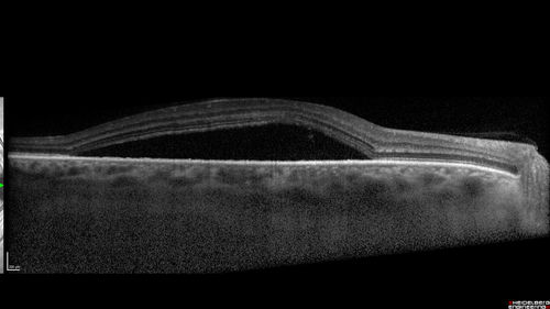 Chronic CSC Both Eyes - Recent vision loss Right Eye Treated with PDT
50 year old man The right eye has had vision loss for a few weeks.  He had previous episodes seen by me in 2012 OS and 2008 OD.  This was 2018. VA OS has been poor for several years.  
VA OD: Dcc20/100 
VA OS: Dcc20/200-3
The patient had PDT to leaky area superotemporal to the fovea 1/2 dose and within 3 months was back up to 20/25.  The last two OCT scans show fluid absorbing
