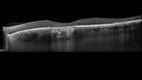Chronic CSC Both Eyes - Recent vision loss Right Eye Treated with PDT
50 year old man The right eye has had vision loss for a few weeks.  He had previous episodes seen by me in 2012 OS and 2008 OD.  This was 2018. VA OS has been poor for several years.  
VA OD: Dcc20/100 
VA OS: Dcc20/200-3
The patient had PDT to leaky area superotemporal to the fovea 1/2 dose and within 3 months was back up to 20/25.  The last two OCT scans show fluid absorbing
