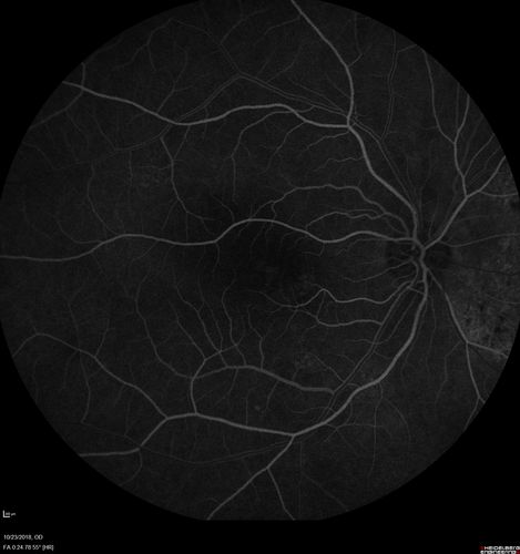 Chronic CSC Both Eyes - Recent vision loss Right Eye Treated with PDT
50 year old man The right eye has had vision loss for a few weeks.  He had previous episodes seen by me in 2012 OS and 2008 OD.  This was 2018. VA OS has been poor for several years.  
VA OD: Dcc20/100 
VA OS: Dcc20/200-3
The patient had PDT to leaky area superotemporal to the fovea 1/2 dose and within 3 months was back up to 20/25.  The last two OCT scans show fluid absorbing
