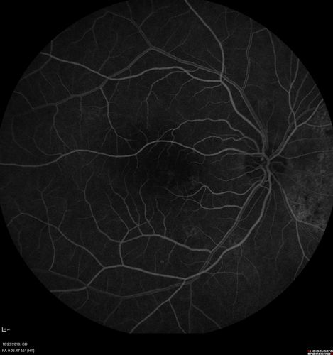 Chronic CSC Both Eyes - Recent vision loss Right Eye Treated with PDT
50 year old man The right eye has had vision loss for a few weeks.  He had previous episodes seen by me in 2012 OS and 2008 OD.  This was 2018. VA OS has been poor for several years.  
VA OD: Dcc20/100 
VA OS: Dcc20/200-3
The patient had PDT to leaky area superotemporal to the fovea 1/2 dose and within 3 months was back up to 20/25.  The last two OCT scans show fluid absorbing
