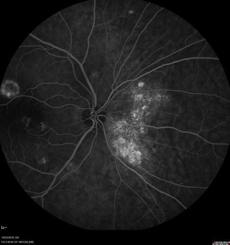 Chronic CSC Both Eyes - Recent vision loss Right Eye Treated with PDT
50 year old man The right eye has had vision loss for a few weeks.  He had previous episodes seen by me in 2012 OS and 2008 OD.  This was 2018. VA OS has been poor for several years.  
VA OD: Dcc20/100 
VA OS: Dcc20/200-3
The patient had PDT to leaky area superotemporal to the fovea 1/2 dose and within 3 months was back up to 20/25.  The last two OCT scans show fluid absorbing
