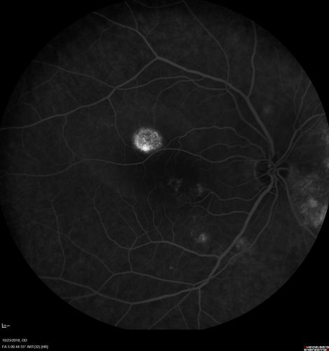 Chronic CSC Both Eyes - Recent vision loss Right Eye Treated with PDT
50 year old man The right eye has had vision loss for a few weeks.  He had previous episodes seen by me in 2012 OS and 2008 OD.  This was 2018. VA OS has been poor for several years.  
VA OD: Dcc20/100 
VA OS: Dcc20/200-3
The patient had PDT to leaky area superotemporal to the fovea 1/2 dose and within 3 months was back up to 20/25.  The last two OCT scans show fluid absorbing
