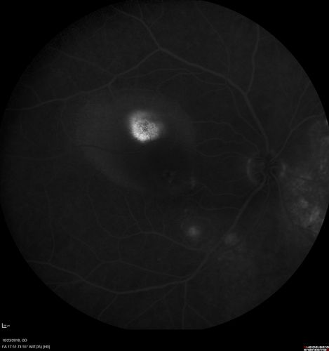 Chronic CSC Both Eyes - Recent vision loss Right Eye Treated with PDT
50 year old man The right eye has had vision loss for a few weeks.  He had previous episodes seen by me in 2012 OS and 2008 OD.  This was 2018. VA OS has been poor for several years.  
VA OD: Dcc20/100 
VA OS: Dcc20/200-3
The patient had PDT to leaky area superotemporal to the fovea 1/2 dose and within 3 months was back up to 20/25.  The last two OCT scans show fluid absorbing
