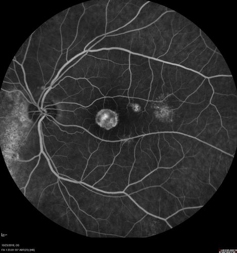 Chronic CSC Both Eyes - Recent vision loss Right Eye Treated with PDT
50 year old man The right eye has had vision loss for a few weeks.  He had previous episodes seen by me in 2012 OS and 2008 OD.  This was 2018. VA OS has been poor for several years.  
VA OD: Dcc20/100 
VA OS: Dcc20/200-3
The patient had PDT to leaky area superotemporal to the fovea 1/2 dose and within 3 months was back up to 20/25.  The last two OCT scans show fluid absorbing
