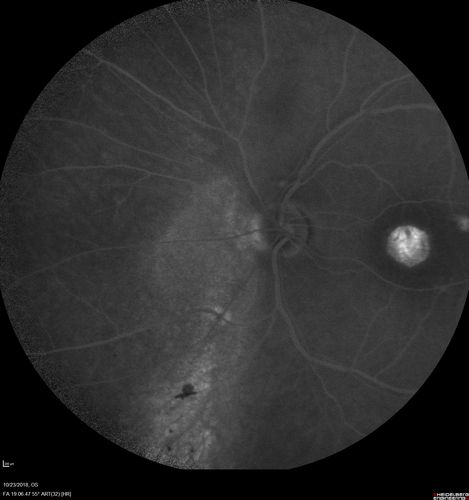 Chronic CSC Both Eyes - Recent vision loss Right Eye Treated with PDT
50 year old man The right eye has had vision loss for a few weeks.  He had previous episodes seen by me in 2012 OS and 2008 OD.  This was 2018. VA OS has been poor for several years.  
VA OD: Dcc20/100 
VA OS: Dcc20/200-3
The patient had PDT to leaky area superotemporal to the fovea 1/2 dose and within 3 months was back up to 20/25.  The last two OCT scans show fluid absorbing
