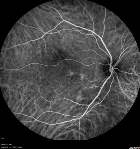 Chronic CSC Both Eyes - Recent vision loss Right Eye Treated with PDT
50 year old man The right eye has had vision loss for a few weeks.  He had previous episodes seen by me in 2012 OS and 2008 OD.  This was 2018. VA OS has been poor for several years.  
VA OD: Dcc20/100 
VA OS: Dcc20/200-3
The patient had PDT to leaky area superotemporal to the fovea 1/2 dose and within 3 months was back up to 20/25.  The last two OCT scans show fluid absorbing
