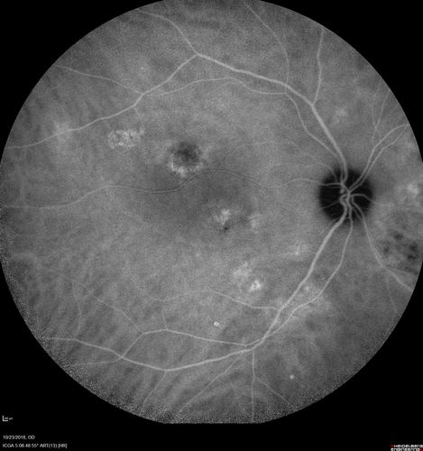 Chronic CSC Both Eyes - Recent vision loss Right Eye Treated with PDT
50 year old man The right eye has had vision loss for a few weeks.  He had previous episodes seen by me in 2012 OS and 2008 OD.  This was 2018. VA OS has been poor for several years.  
VA OD: Dcc20/100 
VA OS: Dcc20/200-3
The patient had PDT to leaky area superotemporal to the fovea 1/2 dose and within 3 months was back up to 20/25.  The last two OCT scans show fluid absorbing
