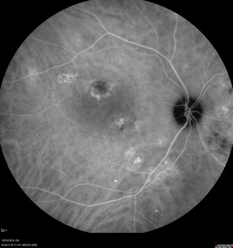 Chronic CSC Both Eyes - Recent vision loss Right Eye Treated with PDT
50 year old man The right eye has had vision loss for a few weeks.  He had previous episodes seen by me in 2012 OS and 2008 OD.  This was 2018. VA OS has been poor for several years.  
VA OD: Dcc20/100 
VA OS: Dcc20/200-3
The patient had PDT to leaky area superotemporal to the fovea 1/2 dose and within 3 months was back up to 20/25.  The last two OCT scans show fluid absorbing
