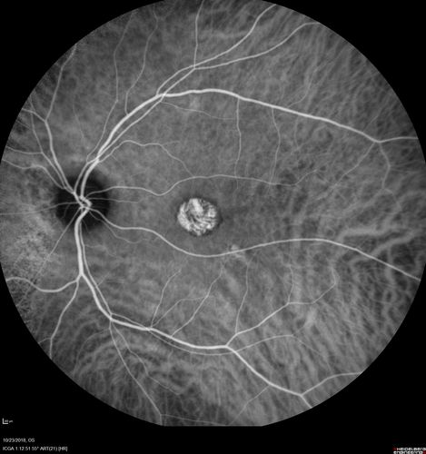 Chronic CSC Both Eyes - Recent vision loss Right Eye Treated with PDT
50 year old man The right eye has had vision loss for a few weeks.  He had previous episodes seen by me in 2012 OS and 2008 OD.  This was 2018. VA OS has been poor for several years.  
VA OD: Dcc20/100 
VA OS: Dcc20/200-3
The patient had PDT to leaky area superotemporal to the fovea 1/2 dose and within 3 months was back up to 20/25.  The last two OCT scans show fluid absorbing
