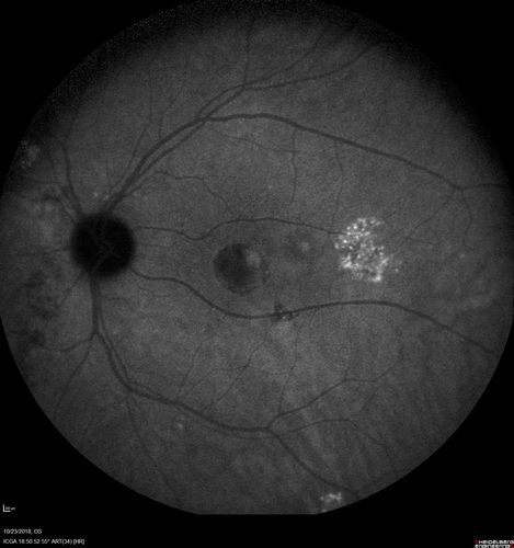 Chronic CSC Both Eyes - Recent vision loss Right Eye Treated with PDT
50 year old man The right eye has had vision loss for a few weeks.  He had previous episodes seen by me in 2012 OS and 2008 OD.  This was 2018. VA OS has been poor for several years.  
VA OD: Dcc20/100 
VA OS: Dcc20/200-3
The patient had PDT to leaky area superotemporal to the fovea 1/2 dose and within 3 months was back up to 20/25.  The last two OCT scans show fluid absorbing
