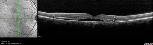 Chronic CSC Both Eyes - Recent vision loss Right Eye Treated with PDT
50 year old man The right eye has had vision loss for a few weeks.  He had previous episodes seen by me in 2012 OS and 2008 OD.  This was 2018. VA OS has been poor for several years.  
VA OD: Dcc20/100 
VA OS: Dcc20/200-3
The patient had PDT to leaky area superotemporal to the fovea 1/2 dose and within 3 months was back up to 20/25.  The last two OCT scans show fluid absorbing
