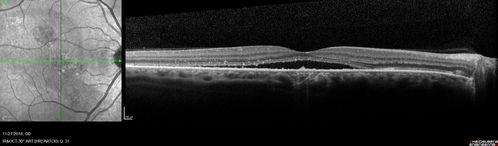 Chronic CSC Both Eyes - Recent vision loss Right Eye Treated with PDT
50 year old man The right eye has had vision loss for a few weeks.  He had previous episodes seen by me in 2012 OS and 2008 OD.  This was 2018. VA OS has been poor for several years.  
VA OD: Dcc20/100 
VA OS: Dcc20/200-3
The patient had PDT to leaky area superotemporal to the fovea 1/2 dose and within 3 months was back up to 20/25.  The last two OCT scans show fluid absorbing
