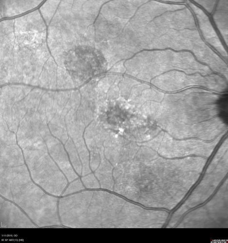 Chronic CSC Both Eyes - Recent vision loss Right Eye Treated with PDT
50 year old man The right eye has had vision loss for a few weeks.  He had previous episodes seen by me in 2012 OS and 2008 OD.  This was 2018. VA OS has been poor for several years.  
VA OD: Dcc20/100 
VA OS: Dcc20/200-3
The patient had PDT to leaky area superotemporal to the fovea 1/2 dose and within 3 months was back up to 20/25.  The last two OCT scans show fluid absorbing
