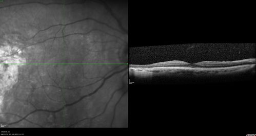 Normal Vision - Chronic Central Serous Chorioretinopathy
67 year old man - never had any symptoms - 20/16 vision in each eye.  Lesions spare the fovea
