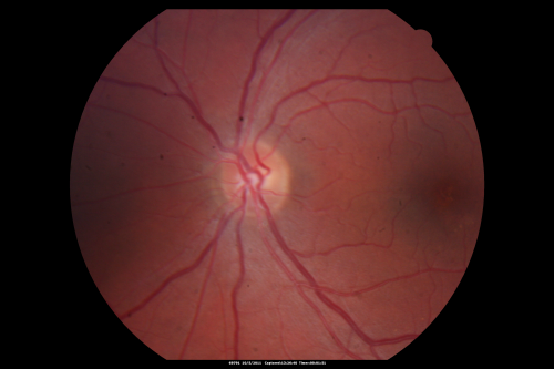 Central Serous Retinopathy Acute 
42-year-old man was seen in the office on October 5, 2011.  He had noticed starting in August after a course of antibiotic and steroids, that he developed new spots in his vision in the right eye.  He may have had an episode like this sometime in the past.  He did take steroids a few years ago and his vision did change at that time, but then returned.  

VISUAL ACUITY:  OD 20/32,  OS 20/32
