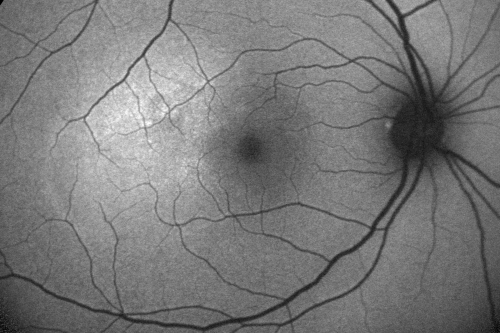 Central Serous Retinopathy Acute - Fundus Autofluorescence
42-year-old man was seen in the office on October 5, 2011.  He had noticed starting in August after a course of antibiotic and steroids, that he developed new spots in his vision in the right eye.  He may have had an episode like this sometime in the past.  He did take steroids a few years ago and his vision did change at that time, but then returned.  

VISUAL ACUITY:  OD 20/32,  OS 20/32
