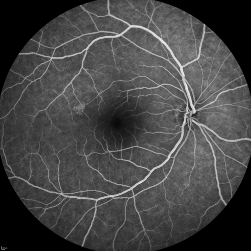 Central Serous Retinopathy Acute  - Fluorescein Angiogram
42-year-old man was seen in the office on October 5, 2011.  He had noticed starting in August after a course of antibiotic and steroids, that he developed new spots in his vision in the right eye.  He may have had an episode like this sometime in the past.  He did take steroids a few years ago and his vision did change at that time, but then returned.  

VISUAL ACUITY:  OD 20/32,  OS 20/32
