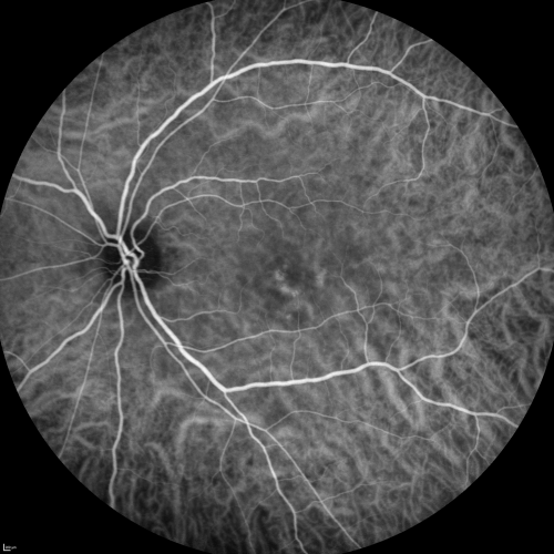 Central Serous Retinopathy Acute - Indocyanine Green Angiogram - Leakage Choriocapillaris 
42-year-old man was seen in the office on October 5, 2011.  He had noticed starting in August after a course of antibiotic and steroids, that he developed new spots in his vision in the right eye.  He may have had an episode like this sometime in the past.  He did take steroids a few years ago and his vision did change at that time, but then returned.  

VISUAL ACUITY:  OD 20/32,  OS 20/32
