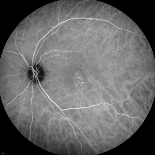 Central Serous Retinopathy Acute - Indocyanine Green Angiogram - Leakage Choriocapillaris 
42-year-old man was seen in the office on October 5, 2011.  He had noticed starting in August after a course of antibiotic and steroids, that he developed new spots in his vision in the right eye.  He may have had an episode like this sometime in the past.  He did take steroids a few years ago and his vision did change at that time, but then returned.  

VISUAL ACUITY:  OD 20/32,  OS 20/32
