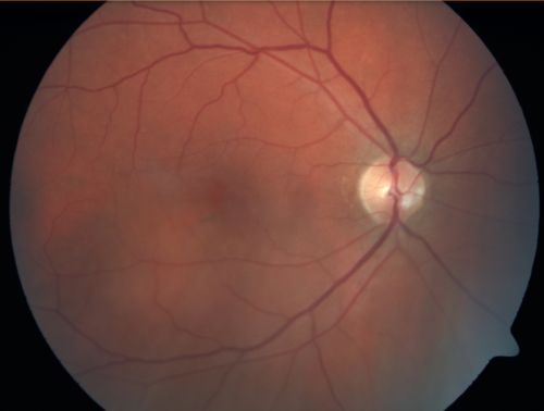 Central Serous Retinopathy - Acute
49-year-old man sees a spot in the central vision with a red halo for 2 weeks OD is 20/50, OS is 20/20
Keywords: csr;central serous retinopathy;ped