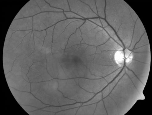 Central Serous Retinopathy - Acute
49-year-old man sees a spot in the central vision with a red halo for 2 weeks OD is 20/50, OS is 20/20
Keywords: csr;central serous retinopathy;ped
