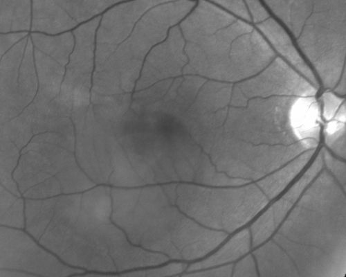 Central Serous Retinopathy - Acute
49-year-old man sees a spot in the central vision with a red halo for 2 weeks OD is 20/50, OS is 20/20
Mots-clés: csr;central serous retinopathy;ped