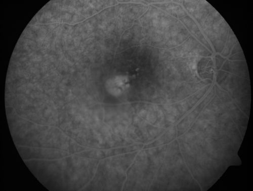 Central Serous Retinopathy - Acute
49-year-old man sees a spot in the central vision with a red halo for 2 weeks OD is 20/50, OS is 20/20
Mots-clés: csr;central serous retinopathy;ped