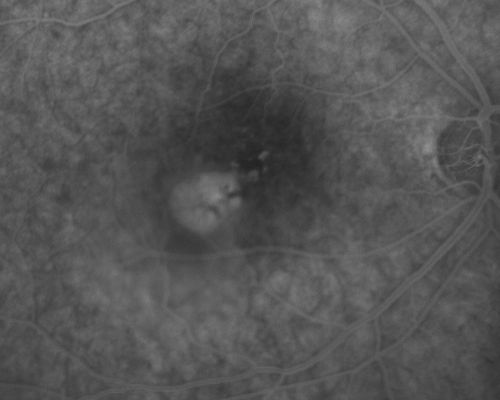 Central Serous Retinopathy - Acute
49-year-old man sees a spot in the central vision with a red halo for 2 weeks OD is 20/50, OS is 20/20
Schlüsselwörter: csr;central serous retinopathy;ped