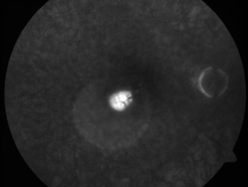 Central Serous Retinopathy - Acute
49-year-old man sees a spot in the central vision with a red halo for 2 weeks OD is 20/50, OS is 20/20
Keywords: csr;central serous retinopathy;ped