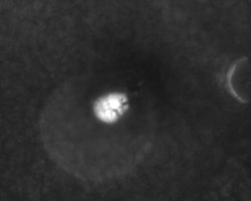 Central Serous Retinopathy - Acute
49-year-old man sees a spot in the central vision with a red halo for 2 weeks OD is 20/50, OS is 20/20
Schlüsselwörter: csr;central serous retinopathy;ped