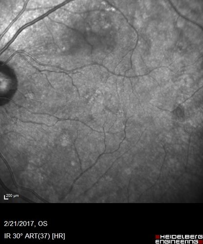 Multifocal Bilateral Central Serous Retinopathy in African American Male
67 year old african american male with : Blurred Vision OD. Duration of Problem: 4-6 weeks. VA 20/32 OD 20/20 OS
