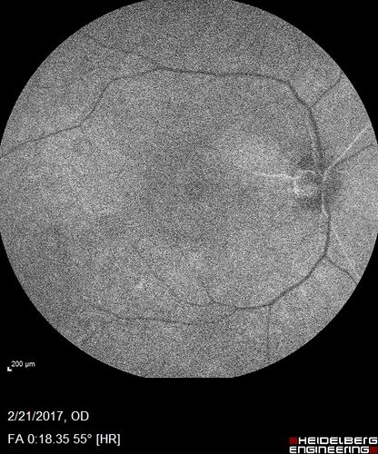 Multifocal Bilateral Central Serous Retinopathy in African American Male
67 year old african american male with : Blurred Vision OD. Duration of Problem: 4-6 weeks. VA 20/32 OD 20/20 OS
