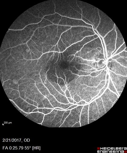 Multifocal Bilateral Central Serous Retinopathy in African American Male
67 year old african american male with : Blurred Vision OD. Duration of Problem: 4-6 weeks. VA 20/32 OD 20/20 OS
