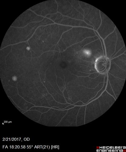 Multifocal Bilateral Central Serous Retinopathy in African American Male
67 year old african american male with : Blurred Vision OD. Duration of Problem: 4-6 weeks. VA 20/32 OD 20/20 OS
