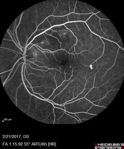Multifocal Bilateral Central Serous Retinopathy in African American Male
67 year old african american male with : Blurred Vision OD. Duration of Problem: 4-6 weeks. VA 20/32 OD 20/20 OS
