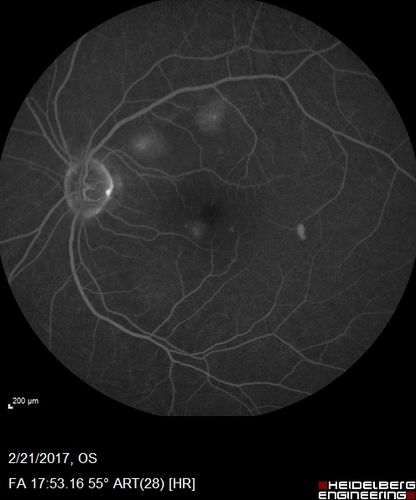 Multifocal Bilateral Central Serous Retinopathy in African American Male
67 year old african american male with : Blurred Vision OD. Duration of Problem: 4-6 weeks. VA 20/32 OD 20/20 OS
