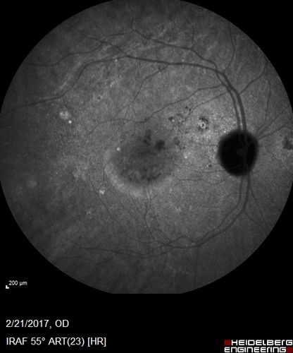 Multifocal Bilateral Central Serous Retinopathy in African American Male
67 year old african american male with : Blurred Vision OD. Duration of Problem: 4-6 weeks. VA 20/32 OD 20/20 OS
