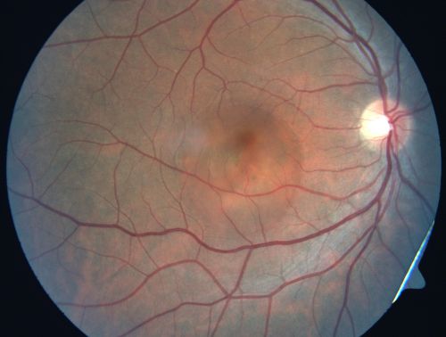 Acute Central Serous Retinopathy (Chorioretinopathy) Right Eye
45-year-old man decreased vision in the right eye starting about two days ago.  VISUAL ACUITY:  Vision OD is 20/60, OS is 20/20.  
