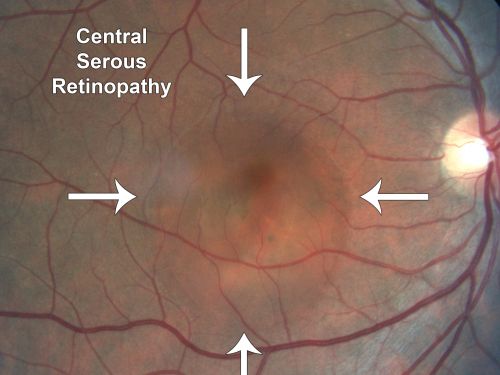 Acute Central Serous Retinopathy (Chorioretinopathy) Right Eye
45-year-old man decreased vision in the right eye starting about two days ago.  VISUAL ACUITY:  Vision OD is 20/60, OS is 20/20.  
