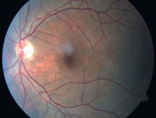 Acute Central Serous Retinopathy (Chorioretinopathy) Right Eye
45-year-old man decreased vision in the right eye starting about two days ago.  VISUAL ACUITY:  Vision OD is 20/60, OS is 20/20.  
