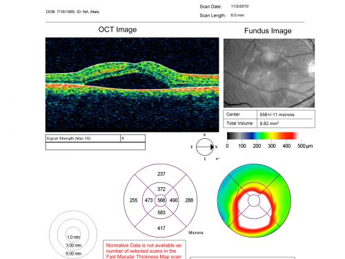 Acute Central Serous Retinopathy (Chorioretinopathy) Right Eye
45-year-old man decreased vision in the right eye starting about two days ago.  VISUAL ACUITY:  Vision OD is 20/60, OS is 20/20.  
