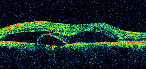 Acute Central Serous Retinopathy (Chorioretinopathy) Right Eye
45-year-old man decreased vision in the right eye starting about two days ago.  VISUAL ACUITY:  Vision OD is 20/60, OS is 20/20.  
