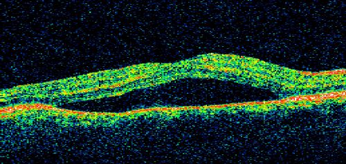 Acute Central Serous Retinopathy (Chorioretinopathy) Right Eye
45-year-old man decreased vision in the right eye starting about two days ago.  VISUAL ACUITY:  Vision OD is 20/60, OS is 20/20.  
