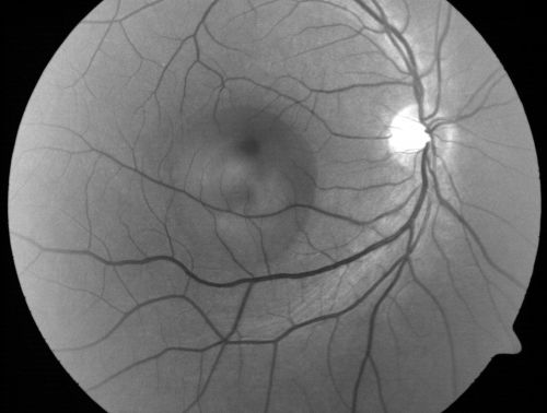 Acute Central Serous Retinopathy (Chorioretinopathy) Right Eye
45-year-old man decreased vision in the right eye starting about two days ago.  VISUAL ACUITY:  Vision OD is 20/60, OS is 20/20.  
