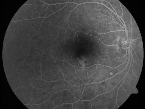 Acute Central Serous Retinopathy (Chorioretinopathy) Right Eye
45-year-old man decreased vision in the right eye starting about two days ago.  VISUAL ACUITY:  Vision OD is 20/60, OS is 20/20.  
