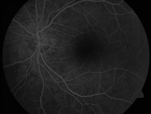 Acute Central Serous Retinopathy (Chorioretinopathy) Right Eye
45-year-old man decreased vision in the right eye starting about two days ago.  VISUAL ACUITY:  Vision OD is 20/60, OS is 20/20.  
