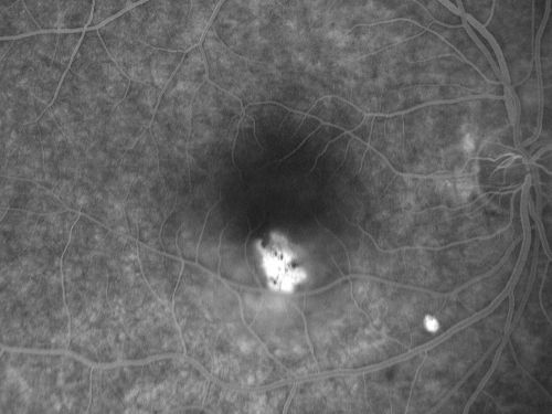 Acute Central Serous Retinopathy (Chorioretinopathy) Right Eye
45-year-old man decreased vision in the right eye starting about two days ago.  VISUAL ACUITY:  Vision OD is 20/60, OS is 20/20.  
